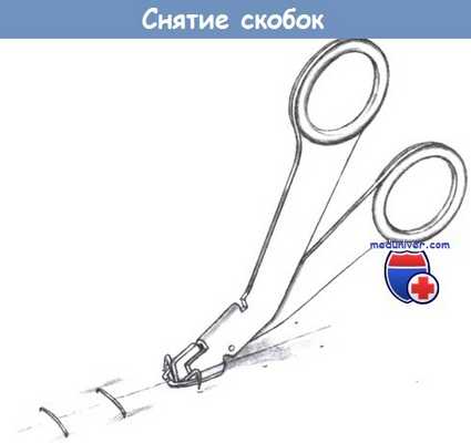 Снятие скобок