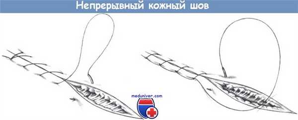 Непрерывный кожный шов
