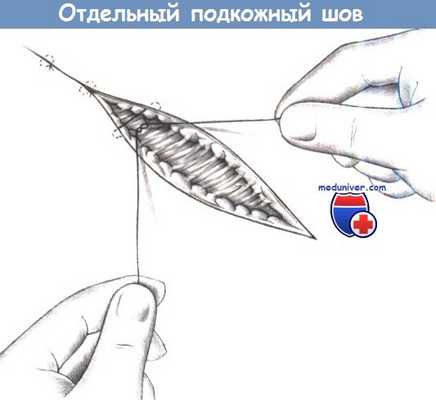 Отдельный подкожный шов