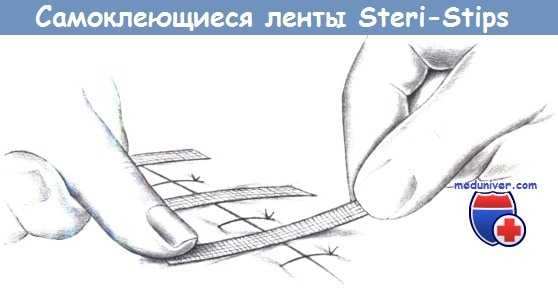 Самоклеющиеся ленты Steri-Strips