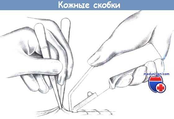Кожные скобки