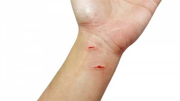 Все ли раны опасны?