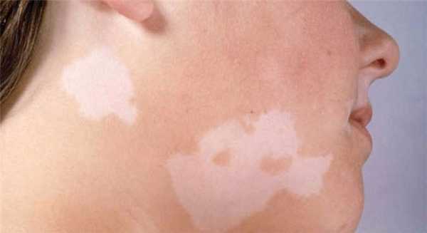 Маскировка витилиго