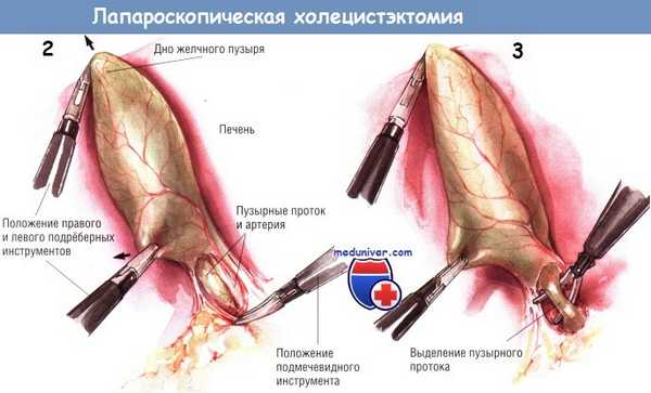 Методика лапароскопической холецистэктомии