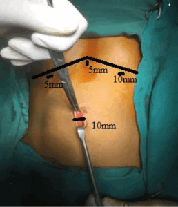 лапароскопическая холециститэктомия
