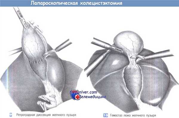 Техника лапароскопической холецистэктомии