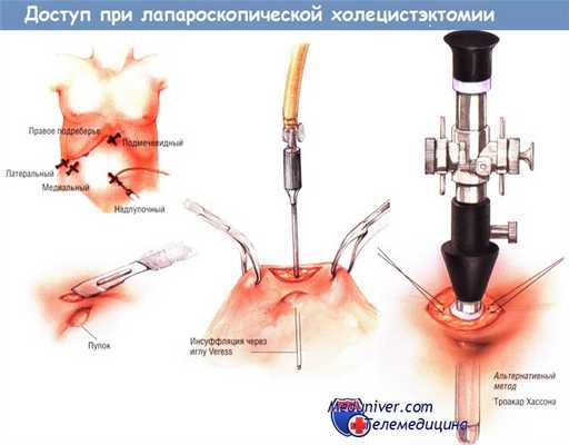 Доступ при лапароскопической холецистэктомии