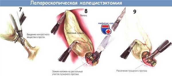 Методика лапароскопической холецистэктомии
