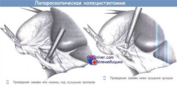 Техника лапароскопической холецистэктомии