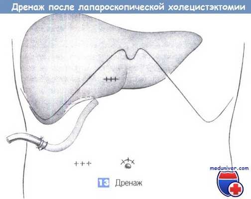 Техника лапароскопической холецистэктомии