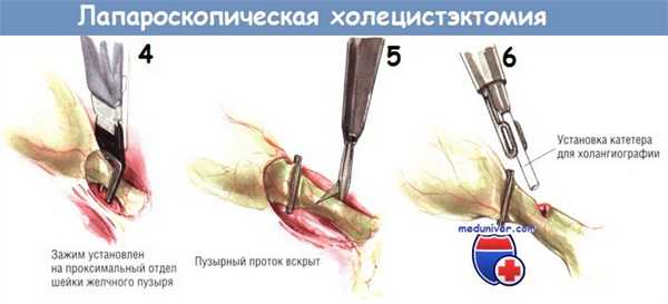 Методика лапароскопической холецистэктомии