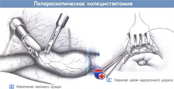 Техника лапароскопической холецистэктомии