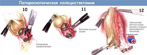 Методика лапароскопической холецистэктомии