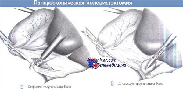Техника лапароскопической холецистэктомии