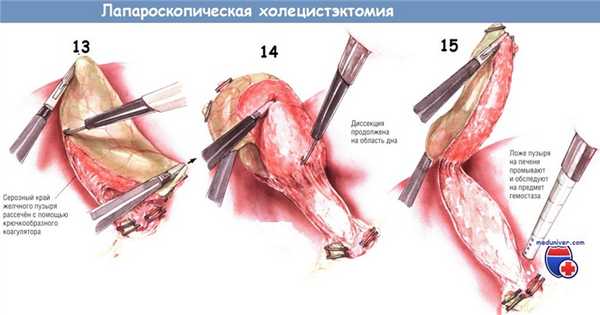 Методика лапароскопической холецистэктомии