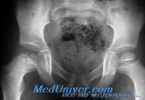 болезнь Легга-Кальве-Пертеса