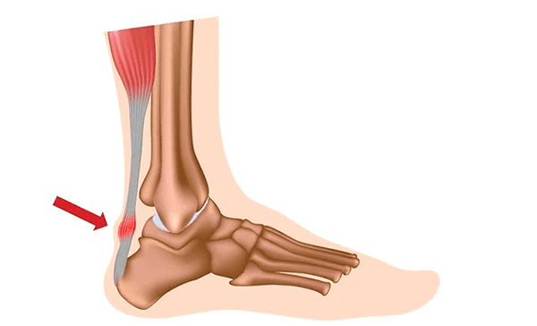 Ахиллово сухожилие
