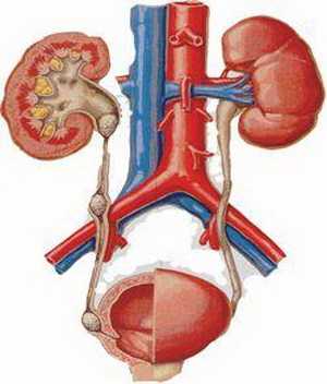 Безоперационное лечение камней в мочеточнике