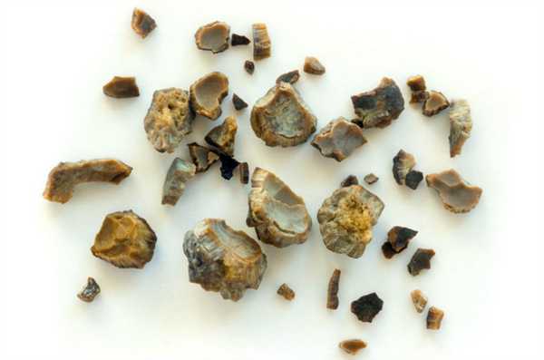 Почечные камни