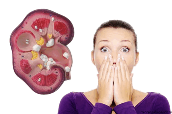 Мочекаменная болезнь