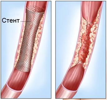 Каркас для расширения протока