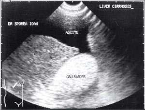 УЗИ: Желчный пузырь, заполненный сладжем, у больного циррозом