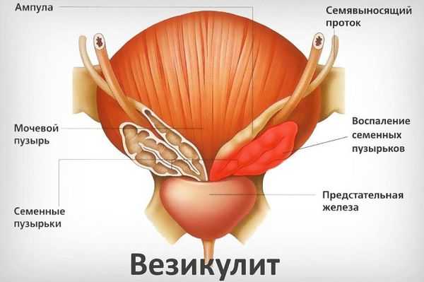 Воспаление семенного пузырька