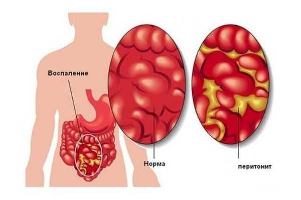 Перитонит