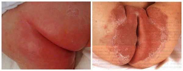 Пелёночный дерматит, осложнённый грибковой инфекцией