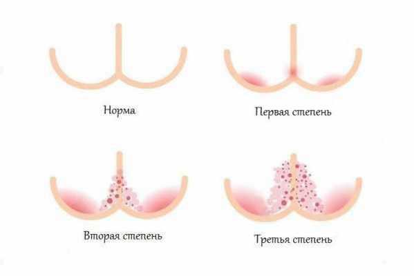 Степени тяжести пелёночного дерматита