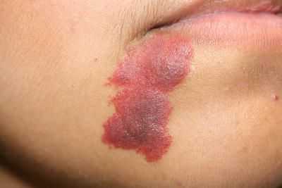 Утолщение и потемнение винного пятна