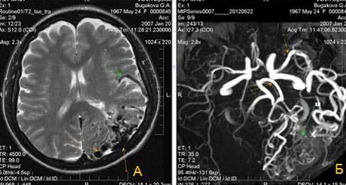 Снимки МРТ и КТ. Капиллярная телеангиэктазия