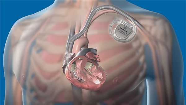 Электрокардиостимулятор спасает жизни