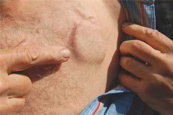 Внешний вид грудной клетки с имплантированным ЭКС