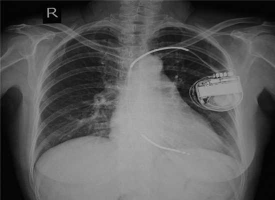 Жизнь с ИКД: физическая нагрузка, особенности