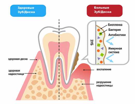 Глубокий кариес