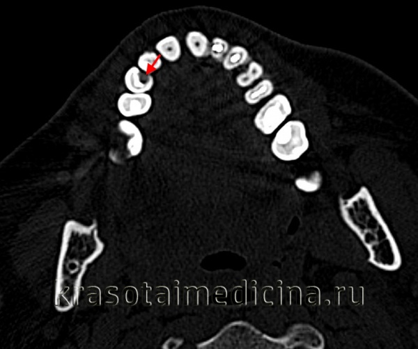 Кариес корня зуба