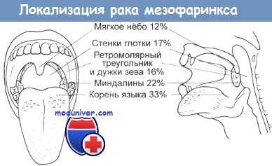 Рак мезофаринкса