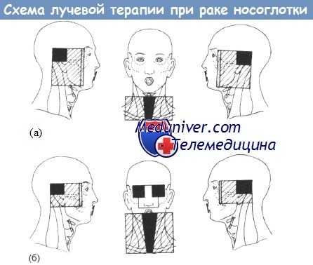 Лучевая терапия при раке носоглотки
