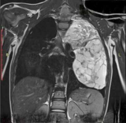 опухоль средостения (рак тимуса)