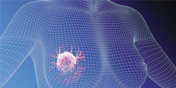 Карцинома молочной железы