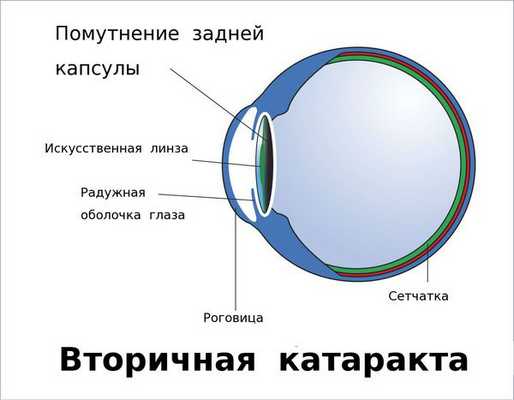Помутнение задней капсулы хрусталика