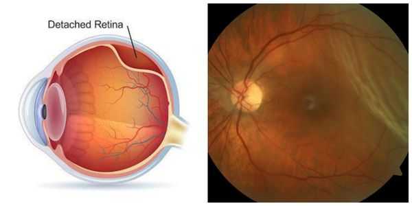 Отслойка сетчатки