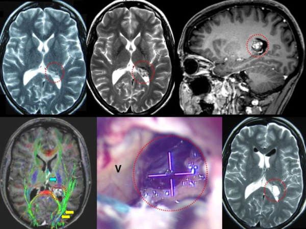 Методы визуализации каверномы головного мозга