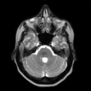 кавернома ствола