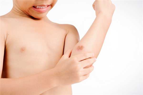 Что такое келоидные рубцы?