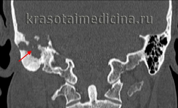 Наружный отит