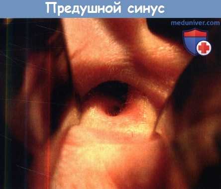 Предушной синус