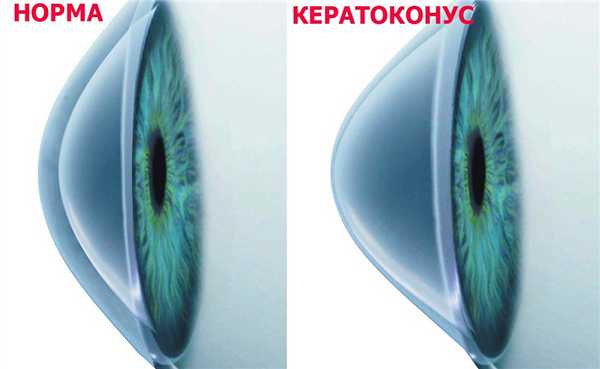 Кератоконус