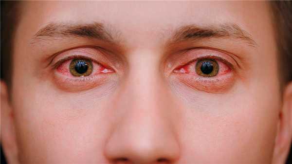 Сезонный конъюнктивит